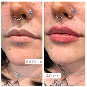 Inyectable1ml 2ml 3ml 5ml Inyecciones de ácido hialurónico reticulado Relleno dérmico/Ha Filler para labios, nariz, arrugas, senos, glúteos, cuerpo, cara, cuello, pliegues